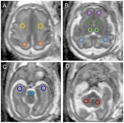 Regional changes in brain apparent diffusion coefficient in fetuses with complex congenital heart disease and normal pregnancy assessed using diffusion-weighted imaging